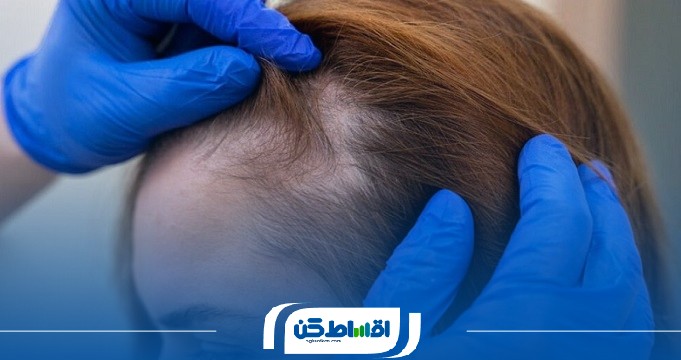 شرایط دریافت کاشت مو اقساطی در تهران