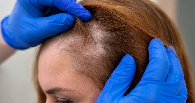 شرایط دریافت کاشت مو اقساطی در تهران