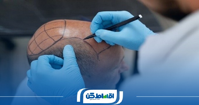 مزایا و چالشهای کاشت مو اقساطی