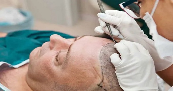 مراحل کاشت مو با پرداخت اقساط در اسلامشهر