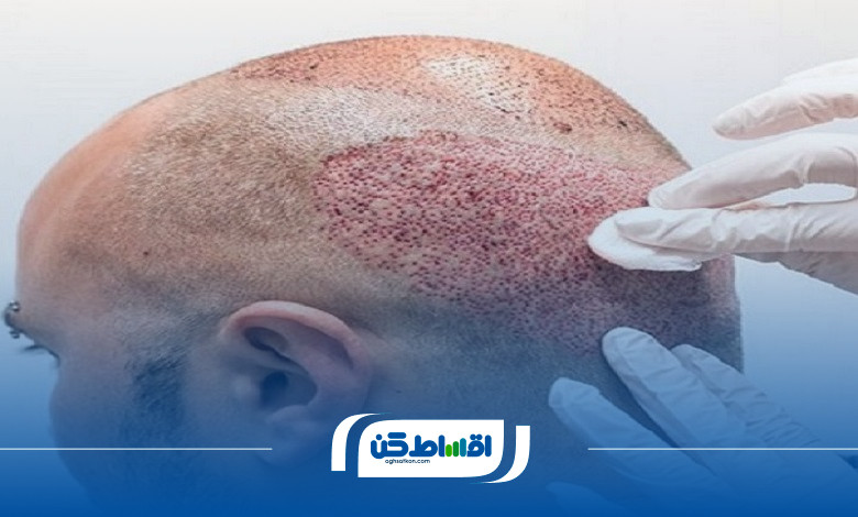 چگونه در رباطکریم برای کاشت مو اقساطی اقدام کنیم