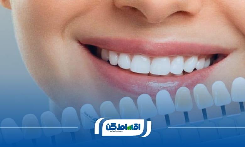 چطور بهترین کلینیک کامپوزیت قسطی را پیدا کنیم؟