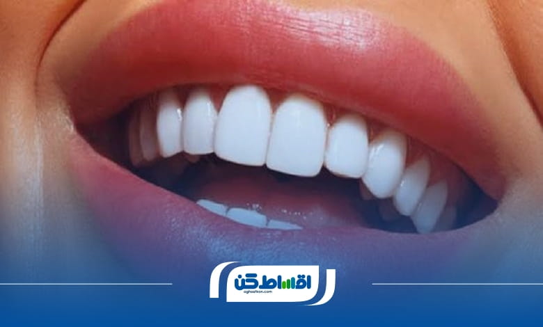 مراحل انجام لمینت دندان اقساطی در کلینیک